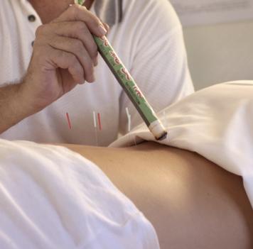 Schwangere setzen auf Akupunktur - verkrzt die Geburt und lindert Schmerzen 